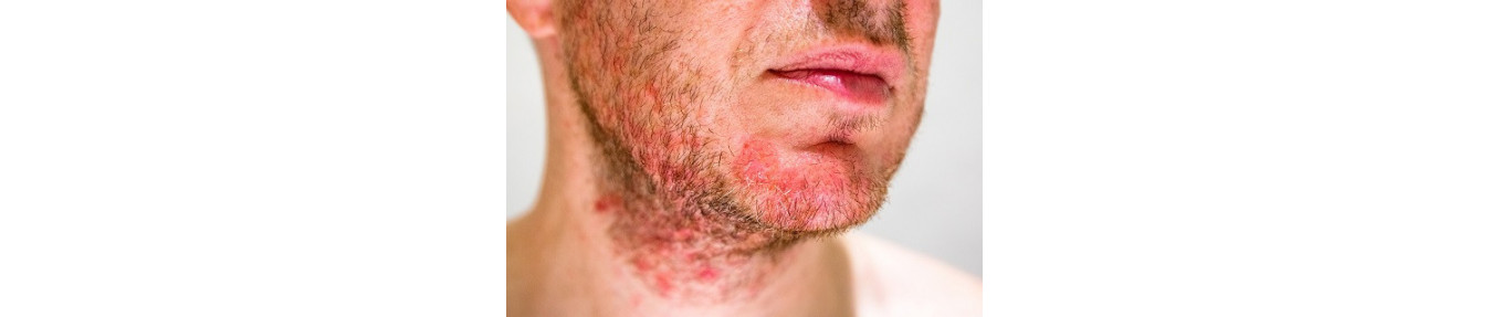 Dermatitis seborreica