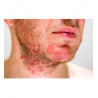 Dermatitis seborreica