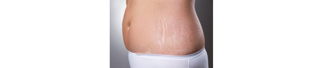 Stretch marks