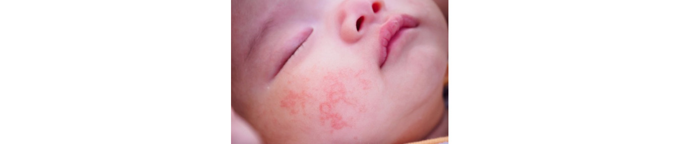 Dermatitis seborreica