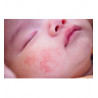 Dermatitis seborreica