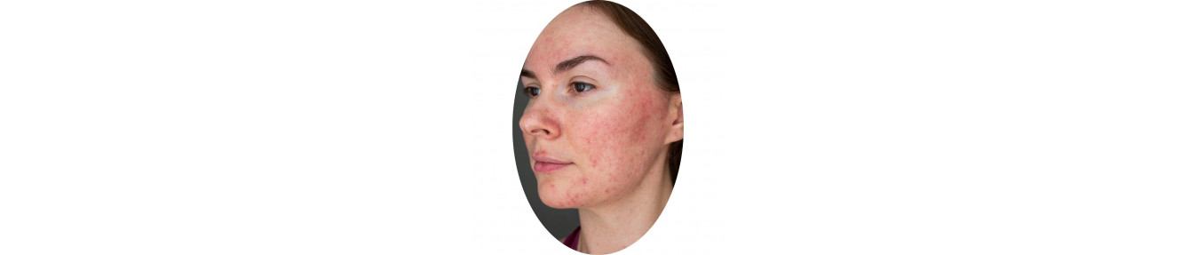 Rosacea solare