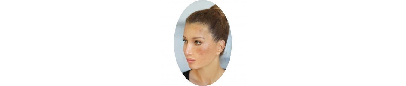 Manchas e Melasma