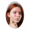 Rosacea und Rötung